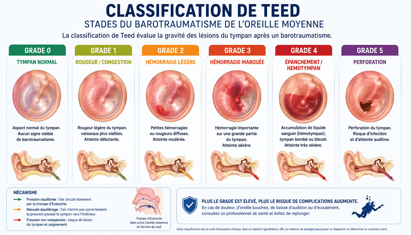 Classification de Teed du barotraumatisme de l'oreille